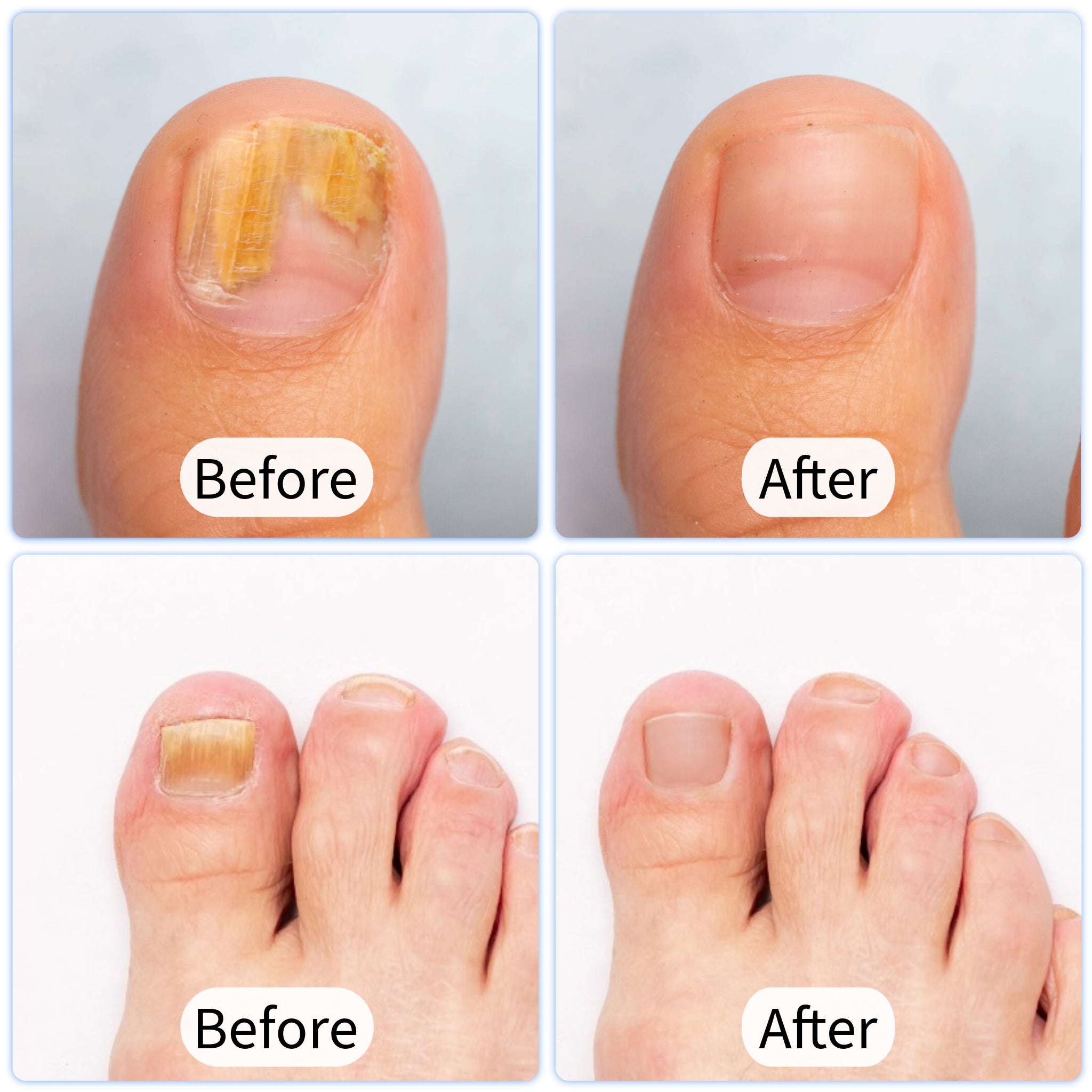 DermaLase